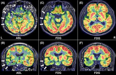 Similar and Differing Distributions Between 18F-FDG-PET and Arterial Spin Labeling Imaging in Temporal Lobe Epilepsy